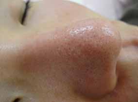 【症例1:治療後】鼻背部中央の大きな陥凹は消失