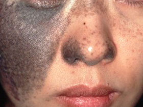 太田母斑：アザ部分のみならず正常部分を含めた顔全体の治療が必要
