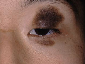 divided nevus：睫毛欠損に注意しての治療が必要