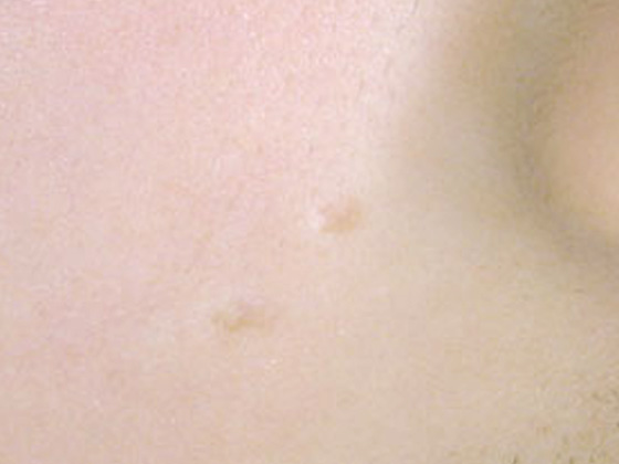 頬部のホクロ除去後の陥凹変形