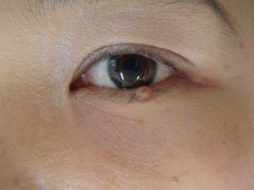 左下眼瞼縁部の色素性母斑：治療前