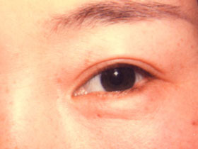 左下眼瞼縁部の色素性母斑：術後2週