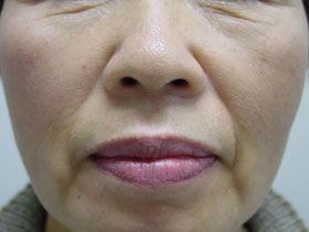 鼻唇溝（法令線）へのヒアルロン酸注入。2014　韓国： 44人が失明