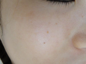 フォトフェイシャルでつくったシミ：治療後