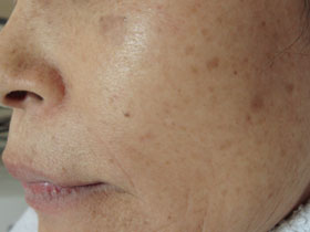 症例1：治療前（68歳女）