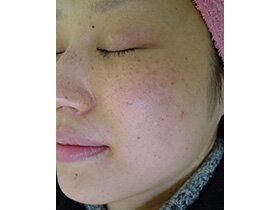 ２００３年：フォトフェイシャルトラブルを解消後の点状色素斑（患者様の許可を得て目隠しなし）