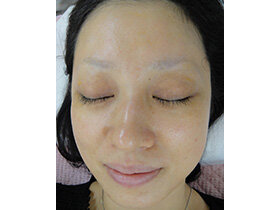 ２００９年：ノーメイク顔（勤務の関係で上下眼瞼・上下口唇赤唇部の色素治療は未施行）