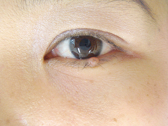 左下眼瞼縁部の色素性母斑：睫毛欠損に注意しての治療が必要