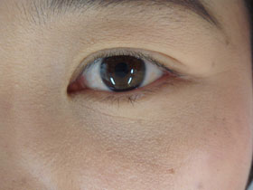 左下眼瞼縁部の色素性母斑：治療後（睫毛を温存した）