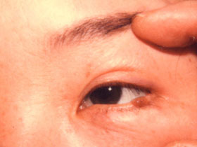 左下眼瞼縁部の色素性母斑：術前