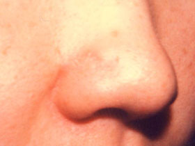 右鼻翼部色素性母斑：術後3ヵ月