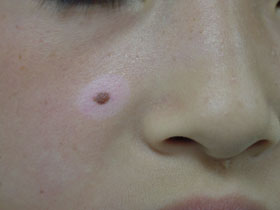 Sutton’s nevus：術前