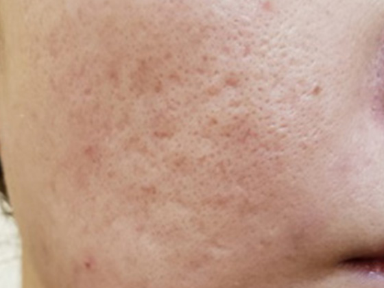 ニキビ痕治療は皮膚の構造を変える必要がある