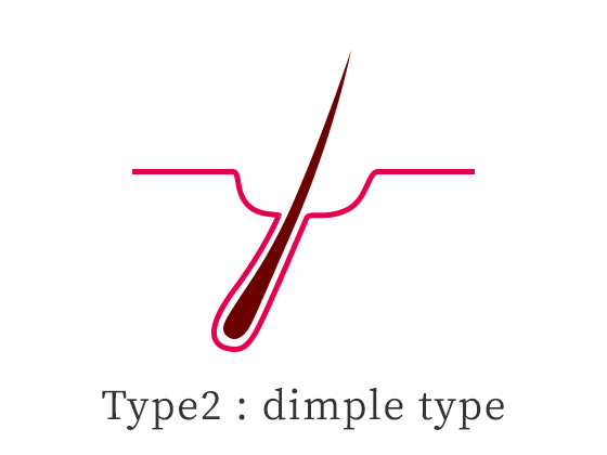 Type 2: dimple type イラスト