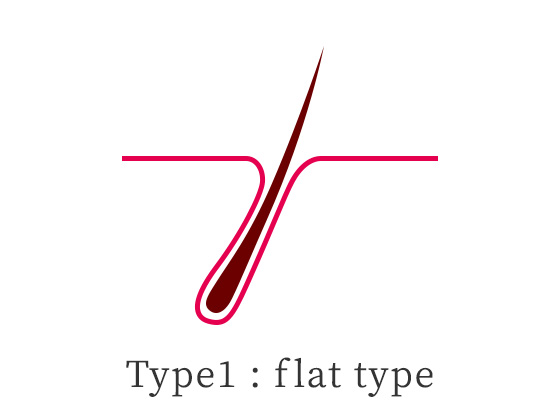 Type 1: flat type イラスト