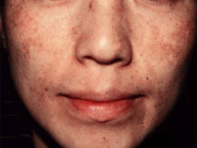 肝斑Type5：顔全体の瀰漫性色素沈着