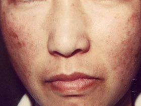 シミのことなら銀座halクリニックへ シミ