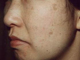 シミのことなら銀座halクリニックへ シミ