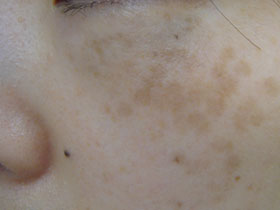 シミのことなら銀座halクリニックへ シミ